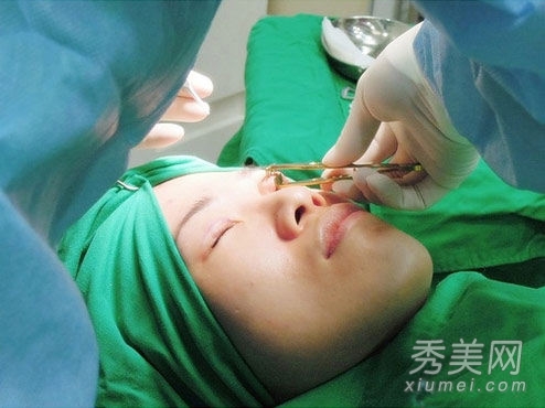 醫學美容：美女自曝雙眼皮手術過程圖