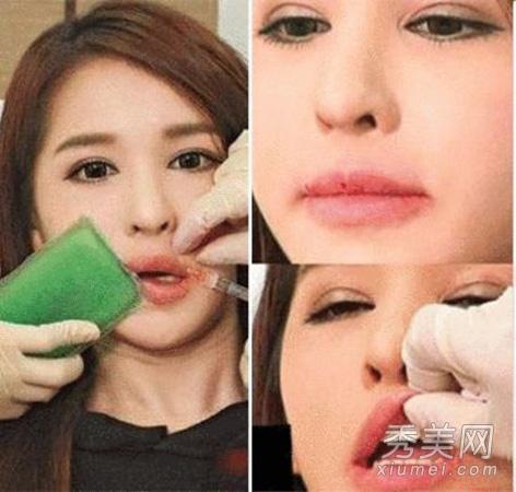 模妈陈静仪注射丰唇 哪些明星做过丰唇手术？