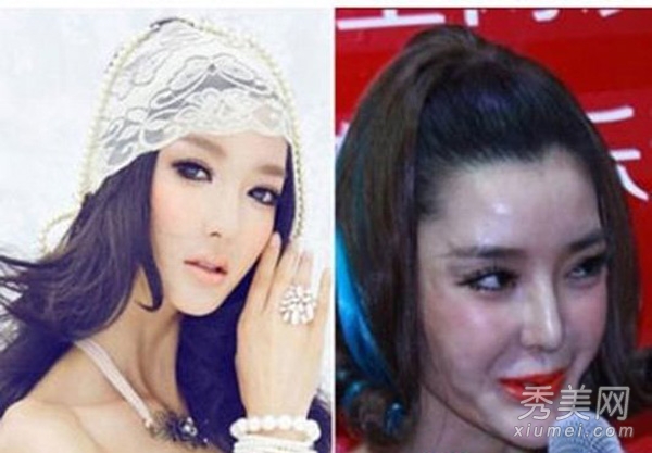 明星爱美整容失败 轻者毁容重者丧命