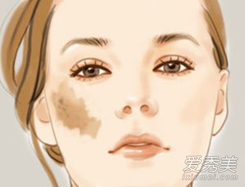 脸上的斑点你有多了解 四种斑点解析 色斑形成的原因