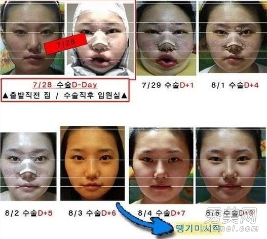 整形全纪录：韩国女人整容前后（图）
