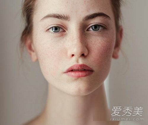 妊娠斑是什么原因 妊娠斑如何祛除 妊娠斑如何预防