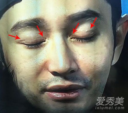 《旋風孝子》黃曉明開眼角+割雙眼皮疤痕暴露（圖） 黃曉明割雙眼皮
