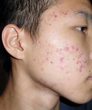 鼻子長痘位置看健康 長痘的原因及祛痘方法 鼻子長痘的原因