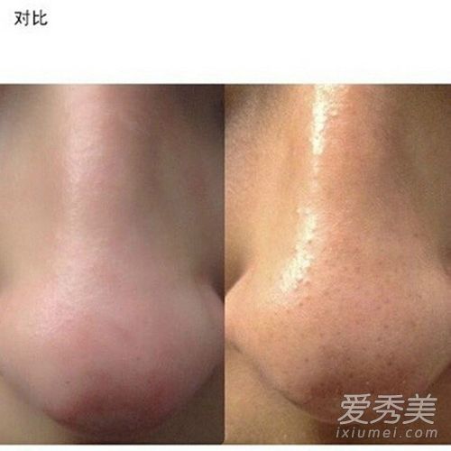 史上最强去黑头 手把手亲测有效 去黑头最有效的方法