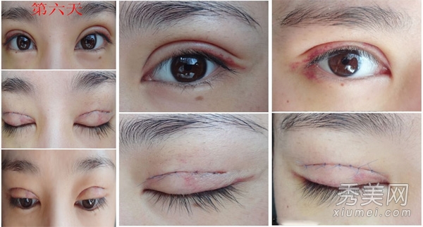 单眼皮MM整形经历 割双眼皮恢复过程图