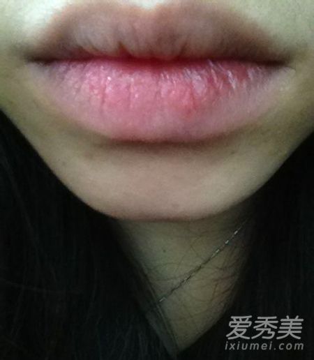 春季嘴唇起皮紅腫 不可盲目塗潤唇膏 過敏性唇炎
