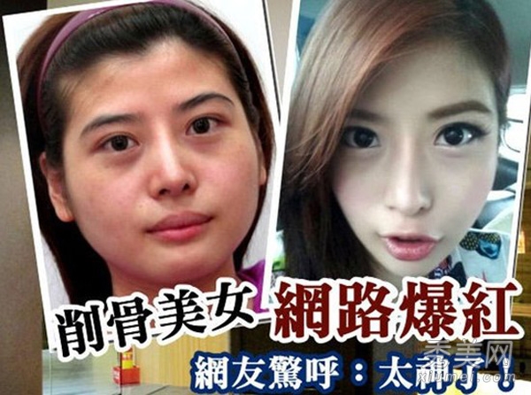 26岁台湾“削骨美女” 整形削骨全过程