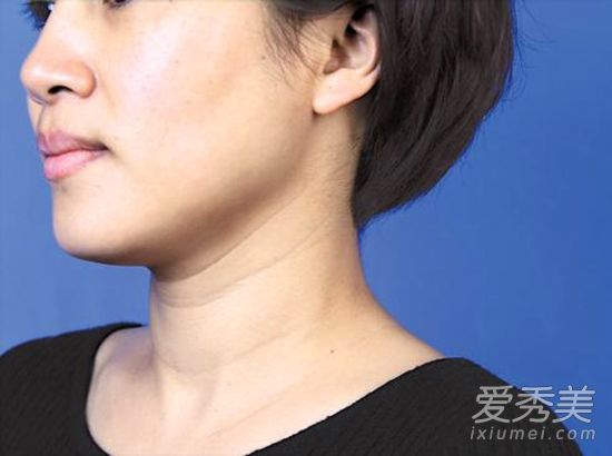 如何预防颈纹形成？颈霜不适合年轻女性 去除颈纹