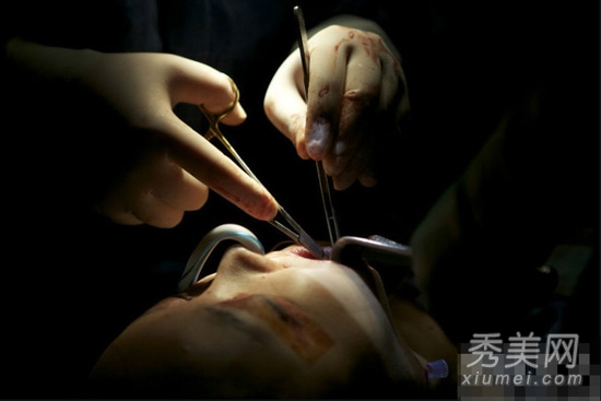 5位韓國整形模特 血腥整容手術高清圖