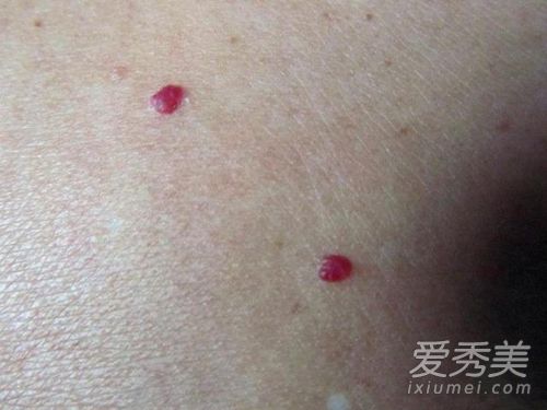 皮肤突然长了小樱桃 红痣到底是怎么回事 血痣是怎么回事