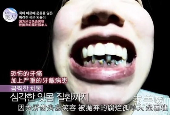 韩国LET美人：腐烂牙丑妇整形变美少女
