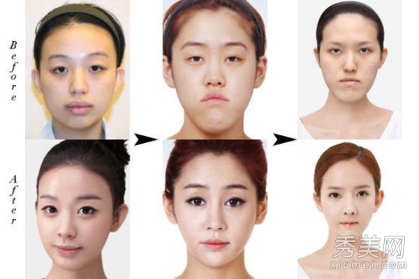韓國《let美人》 醜女整形前後全程揭秘