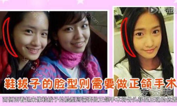 林允儿被曝从头整到脚 肚脐和腿都不放过 林允儿整容前后