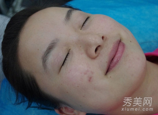 網友親身體驗“柔膚鐳射”醫療美容（圖）