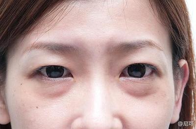 眼袋大是什么原因 眼袋怎么消除简单方法