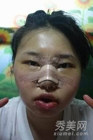 实拍：韩国女人整容过程 削骨抽脂太恐怖