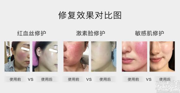 放心!美意生修复敏感肌肉红肿的专业产品,让您每天都享受美丽。