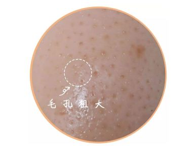 如何改善脸部毛孔粗大?学习这个技巧,以节省移植大毛孔!