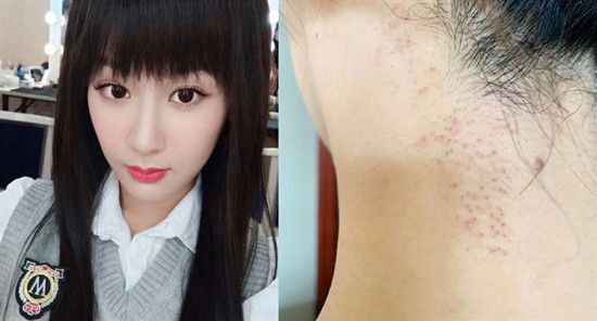 毛孔如何更快消炎?