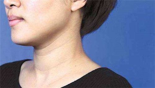 领口是如何形成和去除的