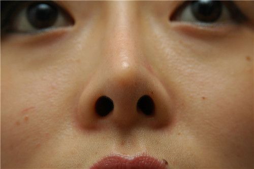 隆鼻会影响月经吗？隆鼻有后遗症吗