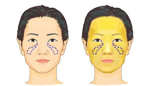 嘿,你能填满眼泪槽吗?嘿,你能填满眼泪槽或透明质酸吗?