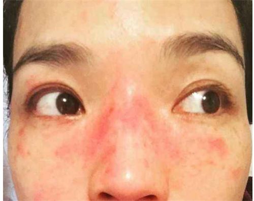 季节性皮肤过敏的症状是什么?过敏肌肉如何保护皮肤?