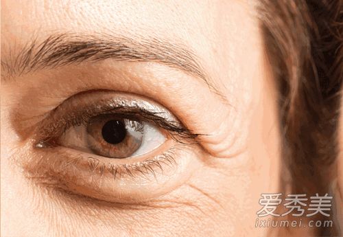 眼袋對麵部表情的影響有多大？80%的女性不知道如何去除眼袋