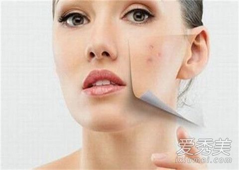 下巴長粉刺的原因是什麼？如何治療下巴上的粉刺？