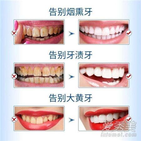 牙齿美白要多少钱？哪种方法对牙齿美白有好处？