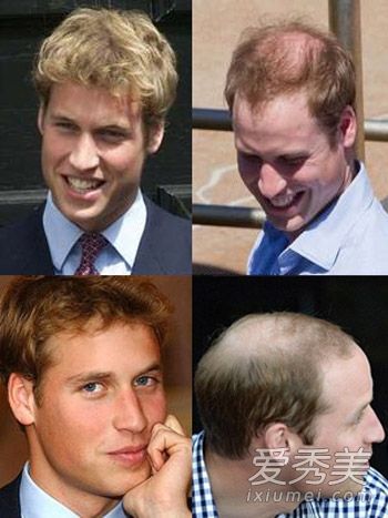 威廉王子是怎么掉头发的？