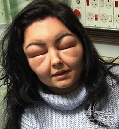年轻女孩对染发剂过敏比整容失败更可怕
