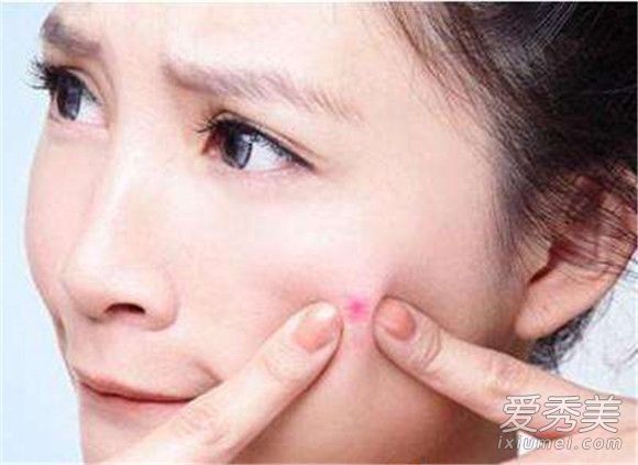 夏天怎么长痘痘？为什么夏天长痘痘