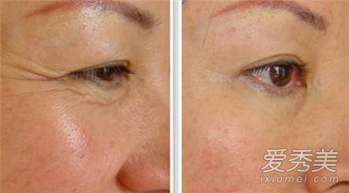 去皱针能去除皱纹吗？去皱针能持续多长时间