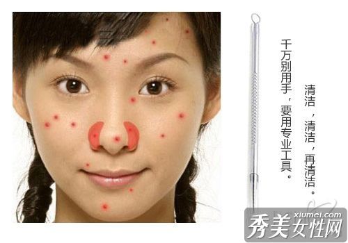痘痒手痒得更厉害,教你安全挤出痘,不留痕迹。