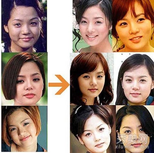 全智贤第一代韩国女演员蔡琳出现整形手术后遗症