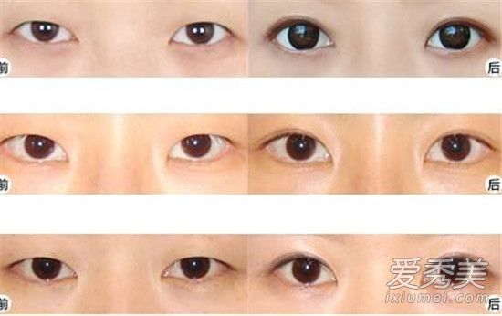 割双眼皮有什么害处?割双眼皮要多少钱?