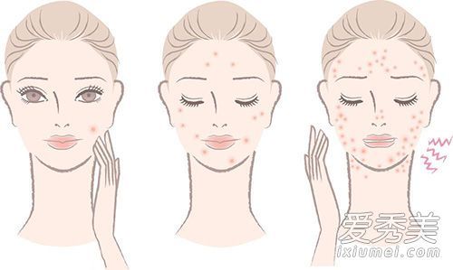 如何预防痤疮以及如何预防痤疮