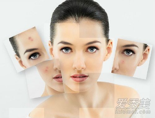 为什么脸上同一地方会长粉刺