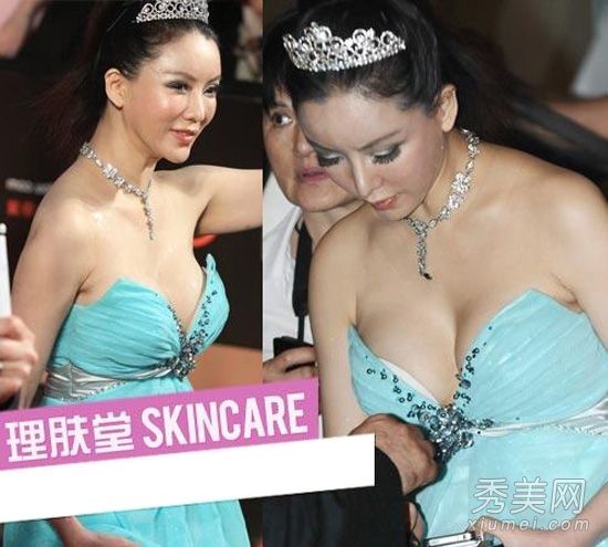 36F色情明星彭丹的面部僵硬引起的红地毯整形手术