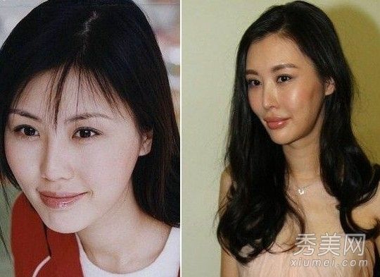 最新整容失败案例:田朴珺、肖强、歪下巴阿达