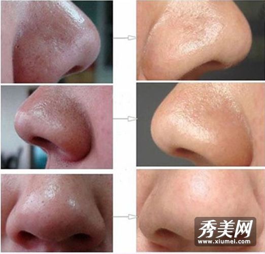 4个自制面膜去除黑头+收缩毛孔