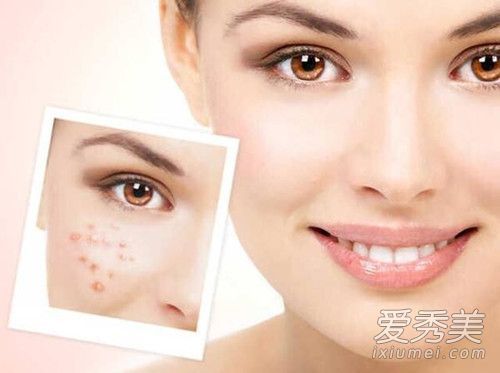 我可以用面膜治疗痤疮吗?如何自制祛痘面膜