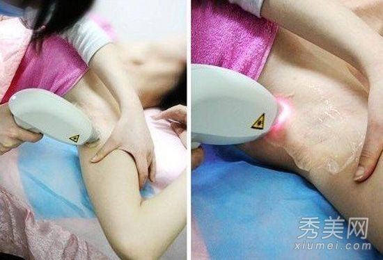 永久性脱毛:激光脱毛的7个注意事项