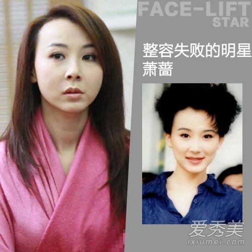 真实案例！明星整容失败会变成这样