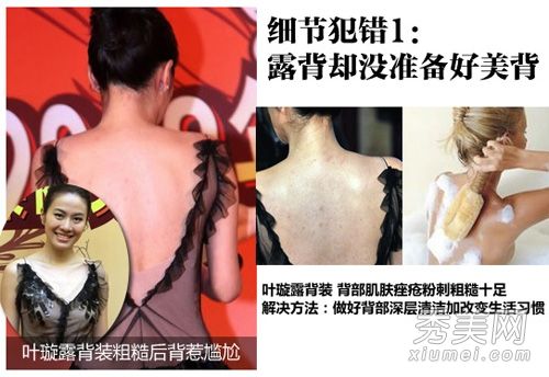 由于维修漏洞，叶璇背上长满粉刺的明星引起了尴尬