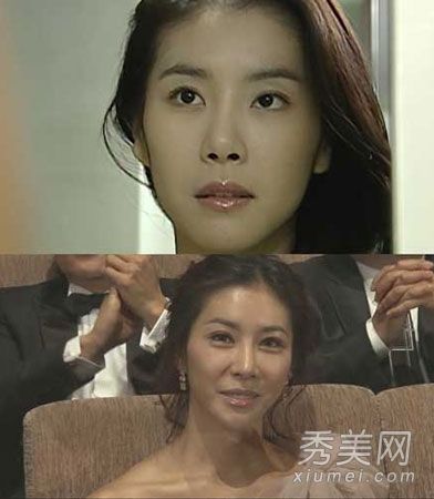 韓國女演員整容後麵部損傷的比較研究