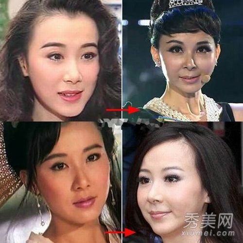 李小璐肖强老年女明星人造高颧骨和娃娃脸的秘密