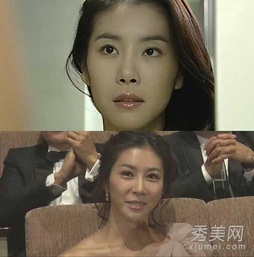 韩国首位整容女演员遭遇后遗症，面部畸形